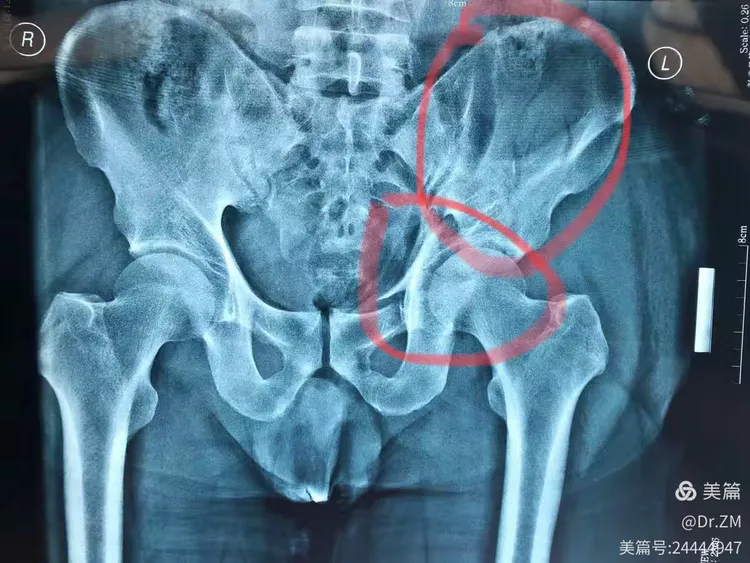 患者为高处坠落伤,左侧骨盆髂骨翼及髋臼前后柱粉碎骨折。这类损伤对患者致残率高,又因其解剖结构原因,周